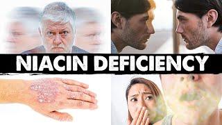 Strange & Weird Niacin B3 Deficiency Signs and Symptoms