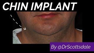 Chin Implant Surgery by @DrScottsdale - Facial Balancing