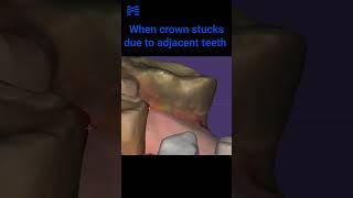 Trouble shooting  When crown stucks due to adjacent teeth