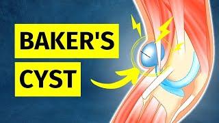 How to ACTUALLY Treat a Bakers Cyst Pain Behind Knee