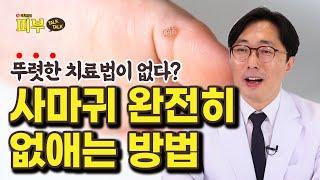 자꾸만 재발하는 사마귀로 고통받고 있다면 ‘이 치료법’을 써보세요 - 박치영의 피부 톡톡 #139