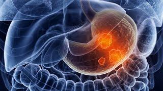 Первые признаки рака желудка прогноз в зависимости от стадии и лечение