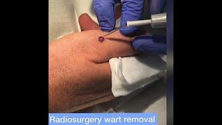 Warts on hand removal by radiosurgery at Cosmedics Skin Clinics London & Bristol