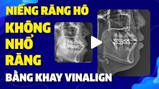 Niềng Răng Hô Không Cần Nhổ Răng Bằng Khay Vinalign  Nam Bùi Vinalign