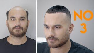 PROTEZ SAÇ - 3 NUMARA SAÇ KESİMİ - Hair Replacement