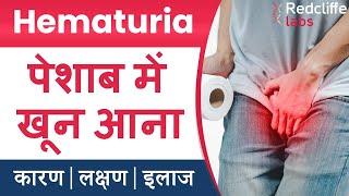 Hematuria पेशाब में खून आना  Symptoms And Causes in Hindi   Hematuria Blood in Urine का इलाज