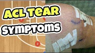 What Does an ACL Tear Feel Like  ACL Tear Symptoms