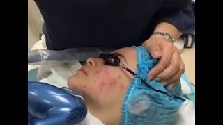 Isolaz Acne Treatment by Enhanze Clinic