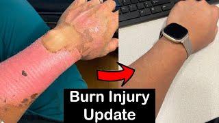 Long Term Healing Progress Of Second Degree Burns 3 Year Update