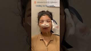 I cried when watching this... #fyp #glowup #facialcontouringsurgery #rhinoplasty #plasticsurgery