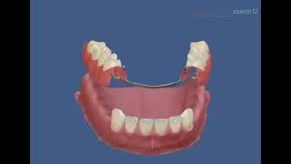 Съемный акриловый зубной протез нижней  челюсти.