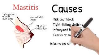 Mastitis - Nyeri payudara saat menyusui atau kehamilan. Gejala dan pengobatan mastitis.