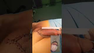 Penile enlargement surgery patient from Kuwait  European and American Urogical  Association member