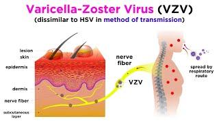 Chickenpox and Shingles Varicella-Zoster Virus