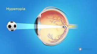 What is Hyperopia Farsightedness?