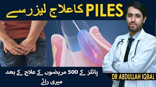 Bawaseer Ka Laser Se Ilaj In Karachi Pak  My 500+ Cases Experience of Piles Surgery With Laser