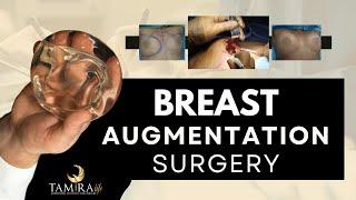 Breast Augmentation with Silicone Implants Procedure l Breast Surgery Quick View l Breast Implant