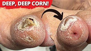 DEEP-Seated Corn Removal On Pinky Toe MUST WATCH