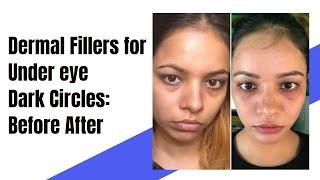 Dermal Fillers in Delhi  Face filler before and after Undereye filler Undereye circle treatment