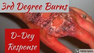 How to deal with 3rd Degree Burns