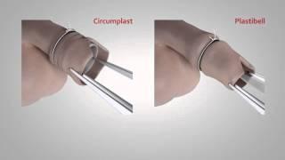 Circumplast vs Plastibell circumcision