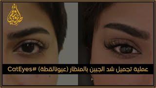 مركز الدكتور طارق قبطي  عملية تجميل شد الجبين بالمنظار #عيون_القطة #CatEyes