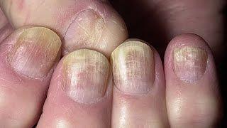 Грибковые заболевания кожи и ногтей  Методы лечения