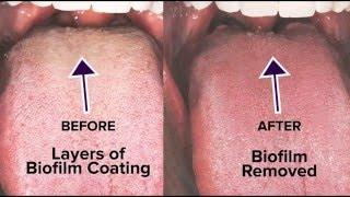 Tongue Rejuvenation The ANSWER to Fixing Chronic Bad Breath & Halitosis