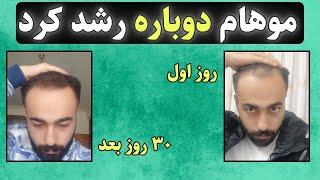 درمان قطعی ریزش مو و رشد مجدد مو در 30 روز