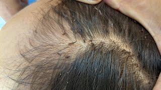 Getting out all most of lice from brown hair - How to remove lice from her head