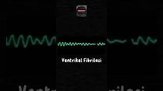 VENTRIKEL FIBRILASI