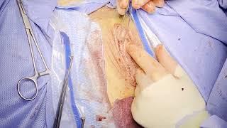 ALVR Procedures Labiaplasty Revision and Clitoral Glans Reduction