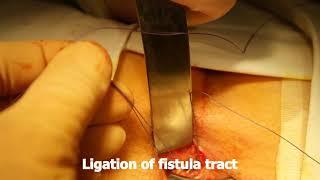 LIFT procedure for a transsphincteric posterior anal fistula