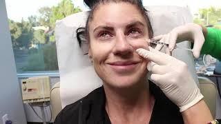 Dysport Injections to the Glabella Crows Feet and Bunny Lines