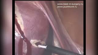 Лапароскопическое иссечение аденомиоза и миомэктомия с временной окклюзией артериального русла