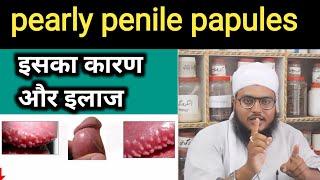 Pearly Penile Papules  लिंग की टॉप पर ये दाने किउ होते है इसका का नुक्सान है @ayurvedahelpyou5804