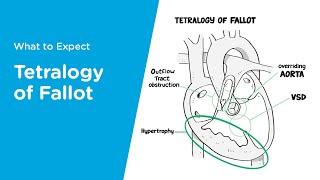 Congenital Heart Defects Explained Tetralogy of Fallot