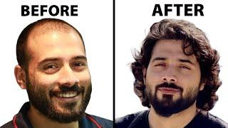 My Remarkable Hair Transplant Journey  Hair Surgeon Reacts