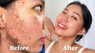 ENG SUB HOW I GOT RID OF MY ACNE SCARS TEXTURE & HYPERPIGMENTATION  *not sponsored*