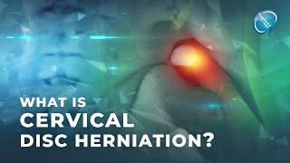 What is Cervical Disc Herniation?  Herniated Disc