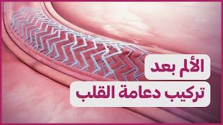 Pain after stent  الألم بعد تركيب دعامة القلب