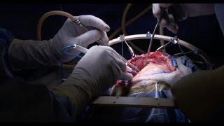 Brain Surgery Craniotomy  Inside the OR
