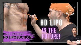 Male Gladiator 360 HD Lipo & Tummy Tuck The FUTURE Is With HD Liposculpture  Dr. Jason Emer