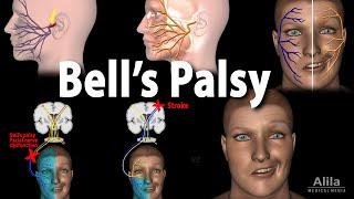 Bells Palsy Pathophysiology Symptoms Diagnosis and Treatment Animation