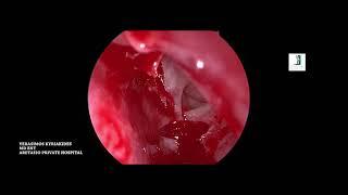 RIGHT ENDOSCOPIC ETHMOIDECTOMY