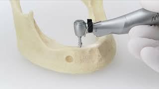 How to Place a Ø4.2x13 mm SEVEN XD Dental Implant