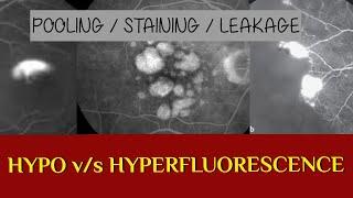 FFA COURSE  HYPERFLUORESCENCE VS HYPO-FLUORESCENCE on FFA