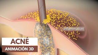 Tratamiento del acné  Animación 3D