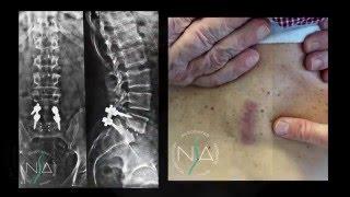 Spondilolistesi L5-S1 artrodesi miniinvasiva tecnica MAS- Plif - NSA Neurochirurgia