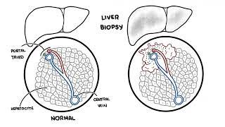 Autoimmune Hepatitis